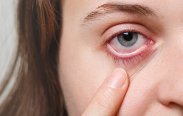 Understanding Dry Eye Disease and Effective Treatment Options